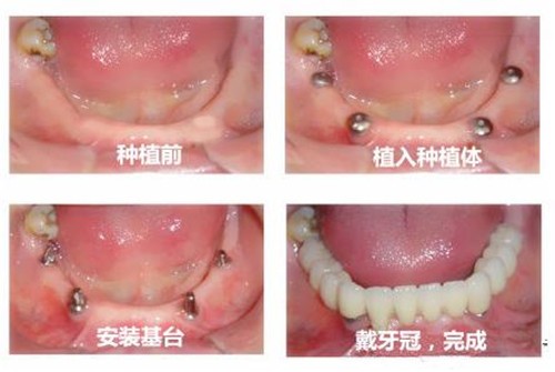 花费8万多种的牙成了四个窟窿